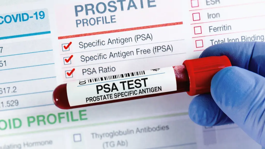 Le cancer de la prostate en forte progression au Royaume-Uni : un enjeu de santé publique majeur