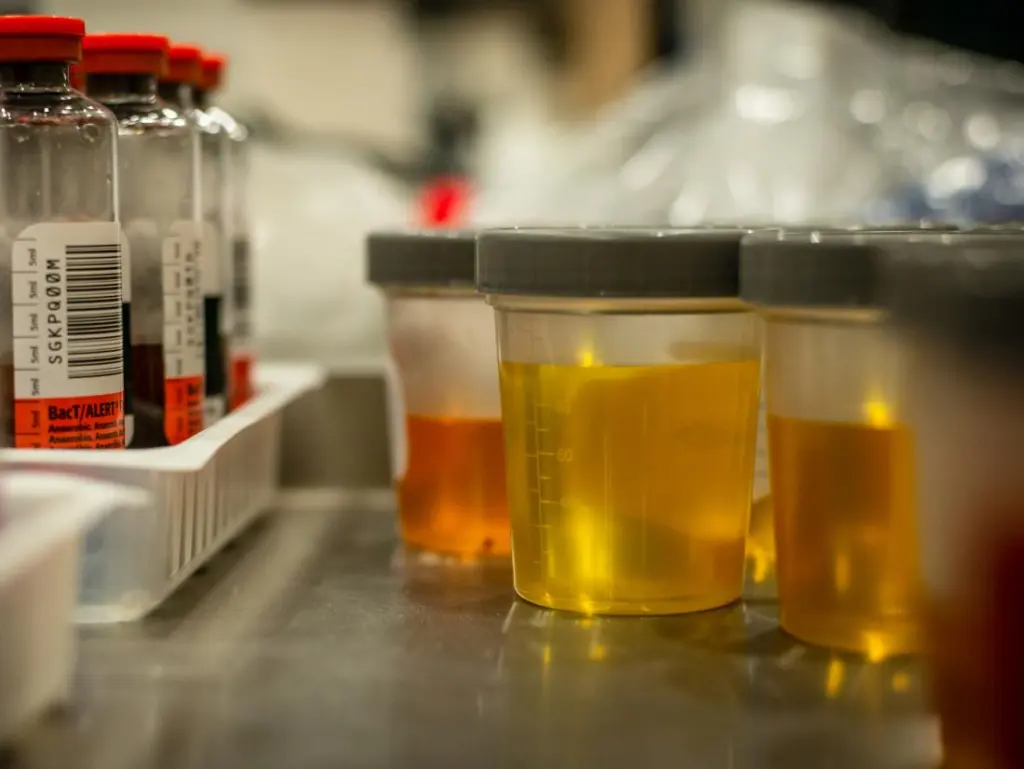 Un test urinaire révolutionnaire détecte 92 % des cancers de la vessie : l’innovation qui pourrait révolutionner le diagnostic
