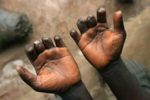 Le Sénégal intensifie sa stratégie de lutte contre la lèpre et l'exclusion sociale à Kaolack