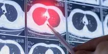 L'arrêt du tabac après un diagnostic de cancer du poumon réduit de moitié le risque de mortalité