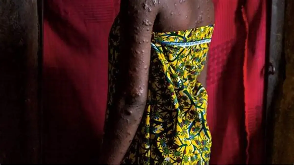 Mpox en Afrique : 1 153 nouveaux cas confirmés en six semaines malgré une stabilisation apparente